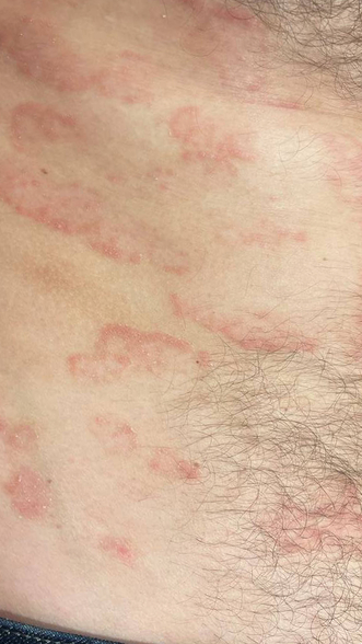 Фото ДО процедуры: Псориаз тела