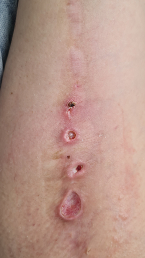 Фото ДО процедуры: Лазерный ожог