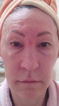 Фото ДО процедуры: Воспаление и отёк лица