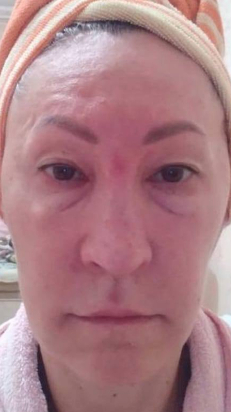 Фото ДО процедуры: Воспаление и отёк лица