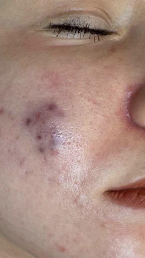 Фото ДО процедуры: Абсцедирующая форма акне