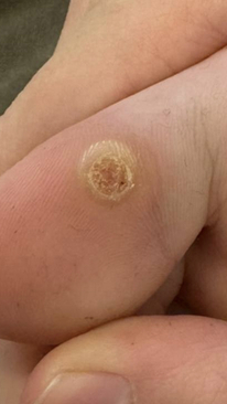 Фото ДО процедуры: Подошвенные бородавки