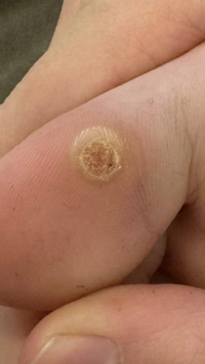 Фото ДО процедуры: Подошвенные бородавки