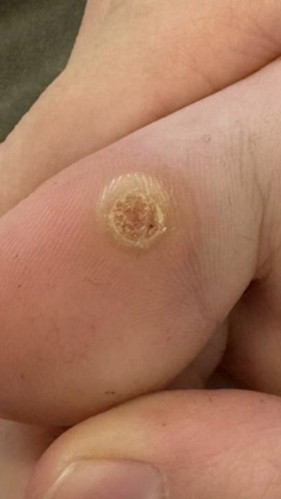 Фото ДО процедуры: Подошвенные бородавки