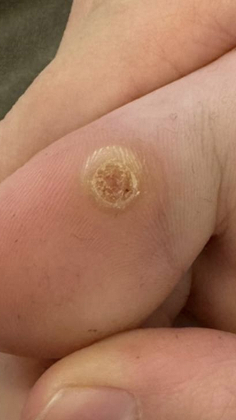 Фото ДО процедуры: Подошвенные бородавки