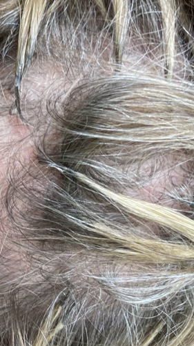 Фото ПОСЛЕ процедуры: Псориаз волосистой части головы