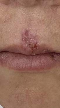 Фото ДО процедуры: Укушенная рана верхней губы