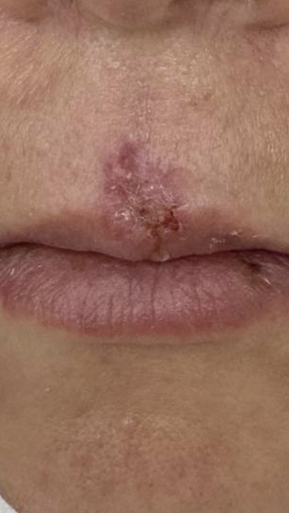 Фото ДО процедуры: Укушенная рана верхней губы