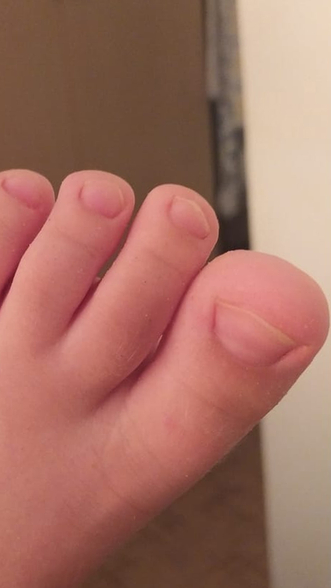 Фото ПОСЛЕ процедуры: Вирусные бородавки