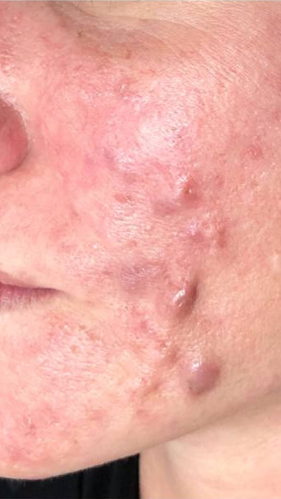 Фото ПОСЛЕ процедуры: Розацеа