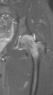 Фото ДО процедуры: Асептический некроз тазобедренного сустава