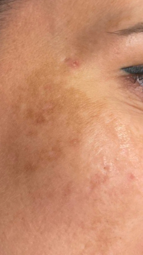 Фото ПОСЛЕ процедуры: Мелазма
