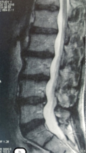 Фото ДО процедуры: Грыжа Диска L4-L5