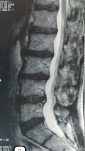 Фото ДО процедуры: Грыжа Диска L4-L5