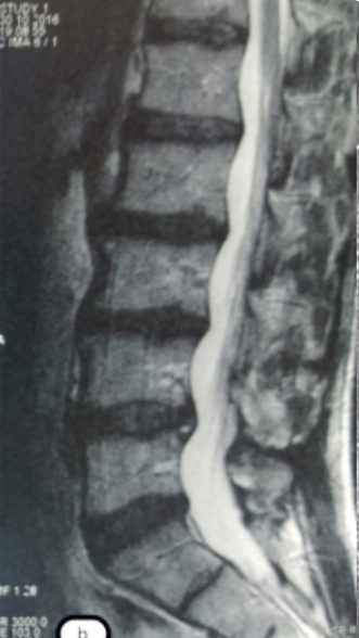 Фото ДО процедуры: Грыжа Диска L4-L5