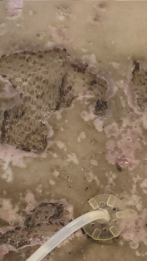 Фото ПОСЛЕ процедуры: Пересадка кожи