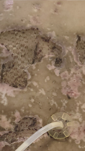 Фото ПОСЛЕ процедуры: Пересадка кожи