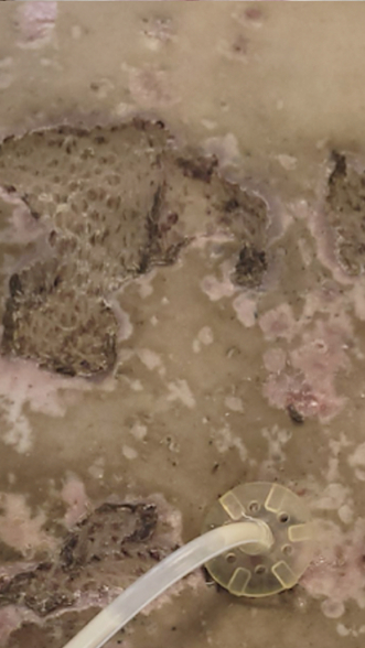 Фото ПОСЛЕ процедуры: Пересадка кожи