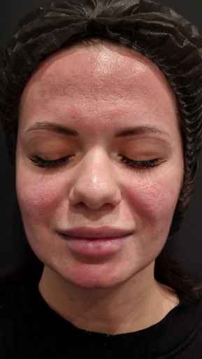 Фото ПОСЛЕ процедуры: После игольчатого RF