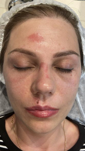 Фото ПОСЛЕ процедуры: Реабилитация после падения