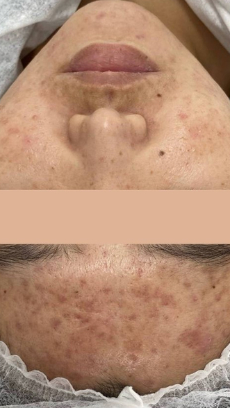 Фото ДО процедуры: Акне