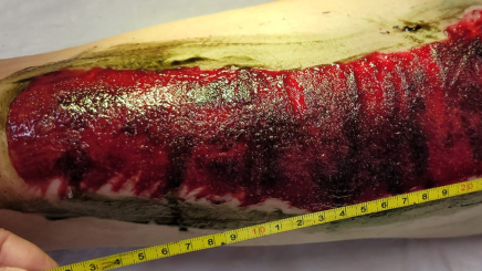 Фото ПОСЛЕ процедуры: Восстановление кожи предплечья