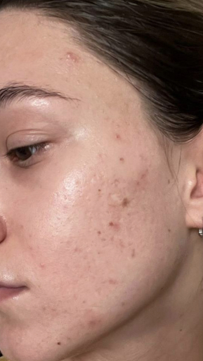 Фото ДО процедуры: Постакне и рубцы