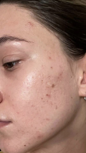 Фото ДО процедуры: Постакне и рубцы