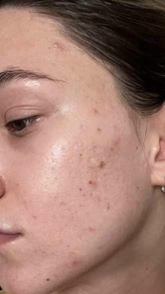 Фото ДО процедуры: Постакне и рубцы