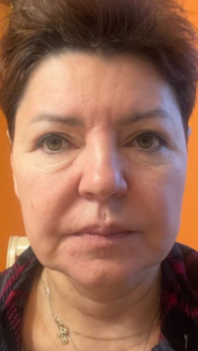 Фото ДО процедуры: Отёк от радиесс