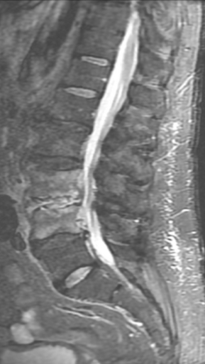 Фото ДО процедуры: Спондилодисцит L3 – L4