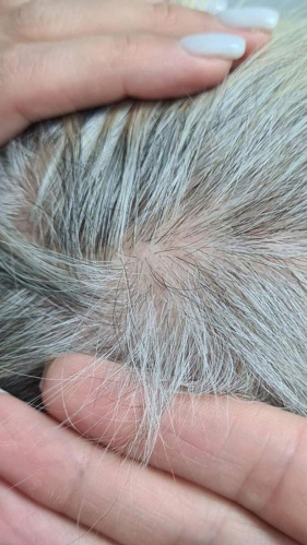 Фото ПОСЛЕ процедуры: Очаговая аллопеция