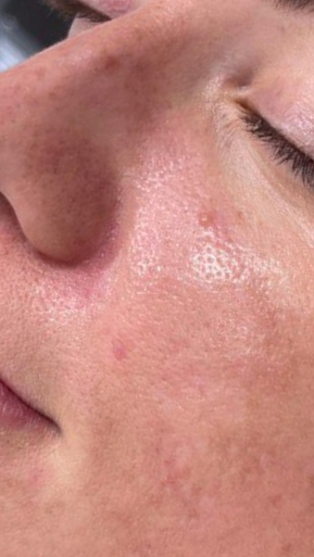 Фото ПОСЛЕ процедуры: Периоральный дерматит