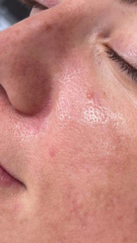 Фото ПОСЛЕ процедуры: Периоральный дерматит