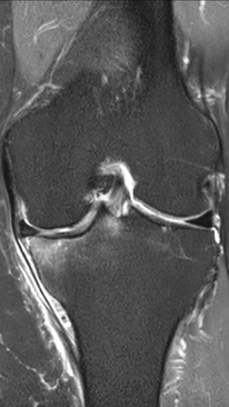 Фото ДО процедуры: Асептический некроз коленного сустава