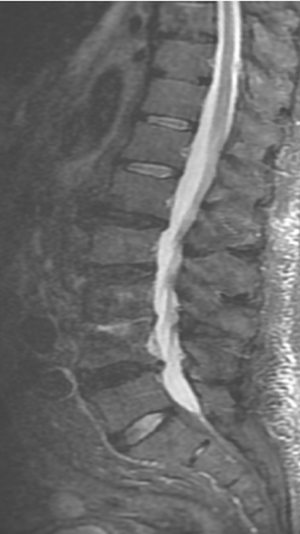 Фото ПОСЛЕ процедуры: Спондилодисцит L3 – L4