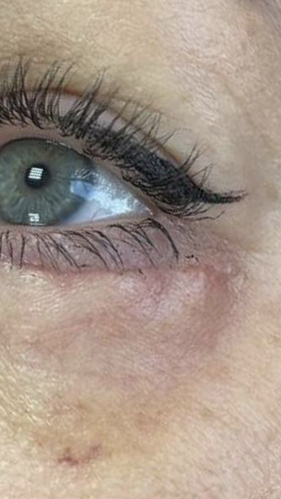 Фото ПОСЛЕ процедуры: Реабилитация после блефаропластики