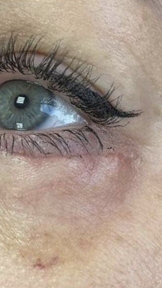 Фото ПОСЛЕ процедуры: Реабилитация после блефаропластики