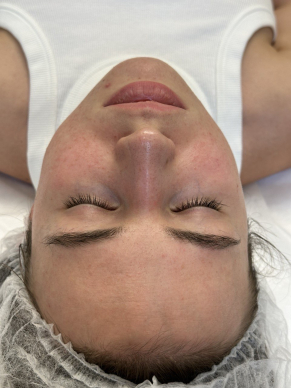 Фото ПОСЛЕ процедуры: Розацеа