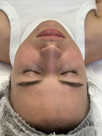 Фото ПОСЛЕ процедуры: Розацеа