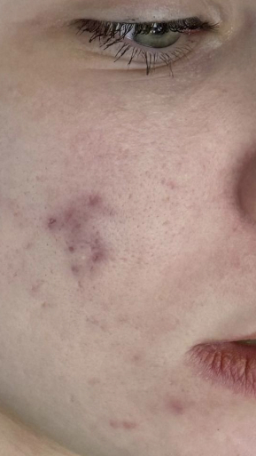 Фото ПОСЛЕ процедуры: Абсцедирующая форма акне