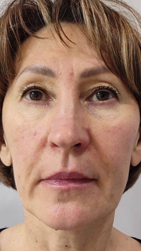 Фото ПОСЛЕ процедуры: Воспаление и отёк лица