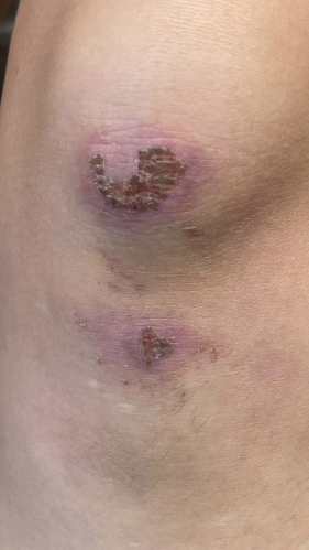 Фото ДО процедуры: Реабилитация после падения