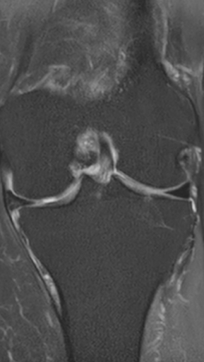 Фото ПОСЛЕ процедуры: Асептический некроз коленного сустава