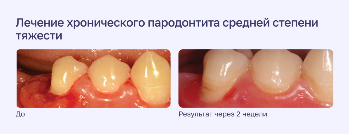 Лечение хронического пародонтита средней степени тяжести