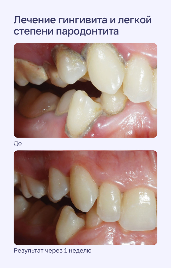 Лечение гингивита и легкой степени пародонтита