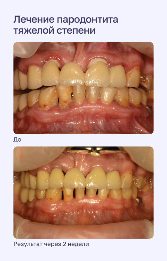 Лечение пародонтита тяжелой степени