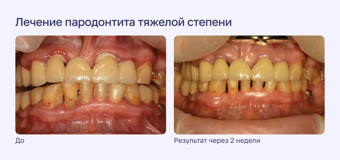 Лечение пародонтита тяжелой степени