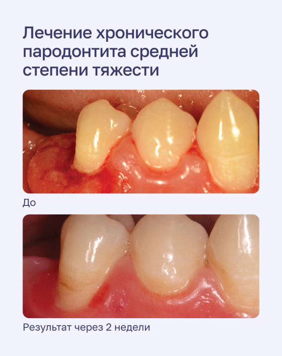 Лечение хронического пародонтита средней степени тяжести
