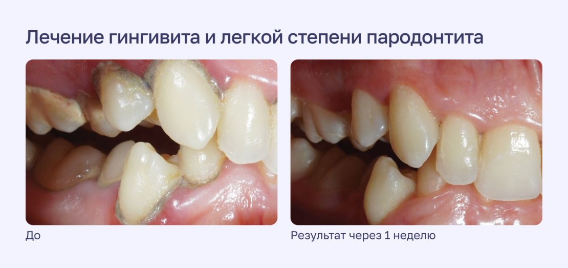 Лечение гингивита и легкой степени пародонтита